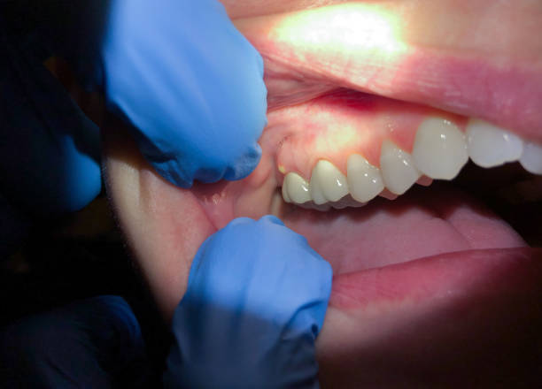 Best Urgent Care for Lost Fillings or Crowns in Keizer, OR